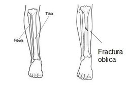 Fractura oblica tibie