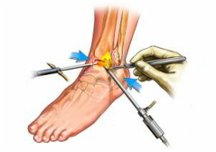 cauze hormonale ale durerilor articulare dureri de picior articulația piciorului