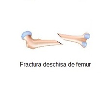 Fractura deschisa femur