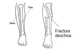 Fractura deschisa tibie