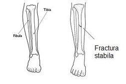 Fractura stabila tibie