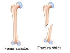 Fractura oblica de femur