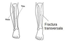 Fractura transversala tibie