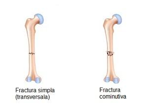 Fractura Ortopedie Arcalife