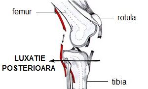 luxația genunchiului tratamentul entorsei și ruperea ligamentelor articulației umărului