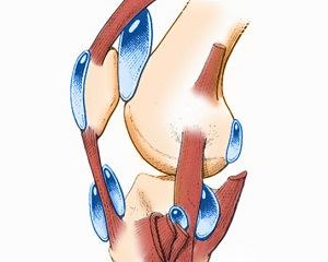 Bursita leziunilor la genunchi