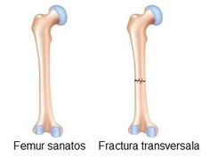 Fractura transversala de femur