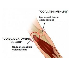 tratamentul inflamației tendoanelor articulației cotului