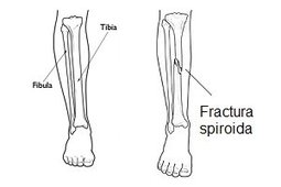 Fractura spiroida tibie