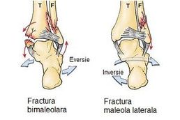 Fracturi de maleole
