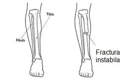 Fractura instabila tibie