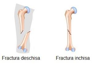 Cum recunosti o fractura | vegeashirts.ro
