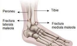 Fractura de peroneu cu lezare glezna