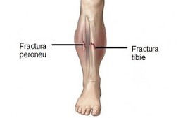 Fractura de tibie si peroneu