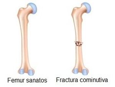 Fractura cominutiva de femur