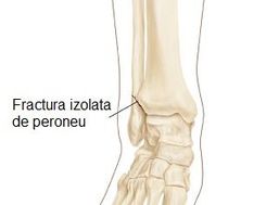 Fractura de peroneu fara lezare glezna