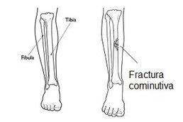 Fractura cominutiva tibie