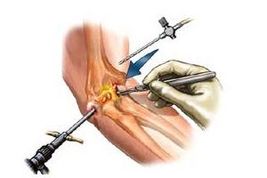 bursita umar tratament durere la tendoanele și ligamentele articulației cotului