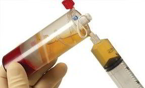 Recuperare dupa artroscopie prin infiltratii cu plasma PRP